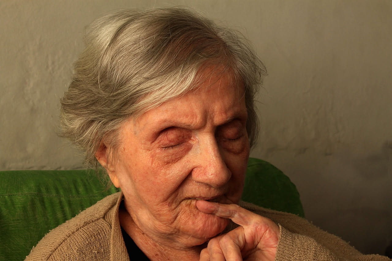 Spalla e schiena di una donna con evidenti arrossamenti da scottatura solare, pelle sensibile e irritata